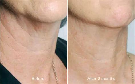 Tretinoin cream is available in concentrations from 0. . Tretinoin on neck before and after